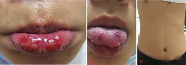 Image result for syphilis ulcer