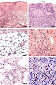 Shingles may consist of nerve pain in the face, feverish system, headache, arm and leg pains, and also swelling. Periocular Necrotizing Soft Tissue Infection In Greater Copenhagen Wurtz 2020 Acta Ophthalmologica Wiley Online Library