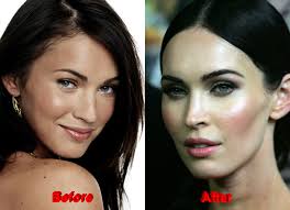 Resultado de imagem para before after surgery