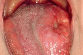 Early detection and timely treatment of oral cancers is important because it greatly increases the chances of survival. Mouth Cancer Oral Cancer Nidirect