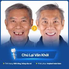 Công nghệ trồng răng từ tính tại Nha khoa ViDental và những ưu việt