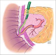 Lingual papillae, small structures on the upper surface of the tongue; Normal Anatomy Of The Major Duodenal Papilla Download Scientific Diagram