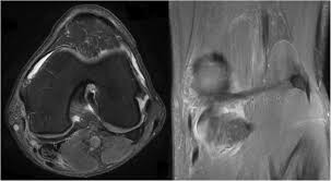 Some of the axial muscles may seem to blur the boundaries because they cross. An Anomalous Band Originating From The Fabella Causing Semimembranosus Impingement Presenting As Knee Pain A Case Report Journal Of Medical Case Reports Full Text