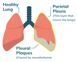 Cancerous tumors develop in the pleura, the thin membrane that lines . Malignant Mesothelioma Cancer Stages Prognosis Treatment