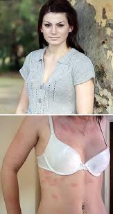 10 People With Unbelievable Medical Conditions Rare Skin Disorders Painful Rash Medical Conditions