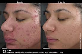 Read honest and unbiased product reviews from our users. Jan Marini Skincare Malmin
