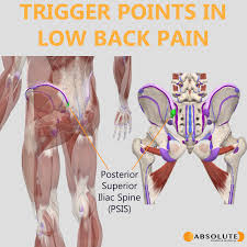 462 x 362 png 37 кб. Trigger Points For Low Back Pain Absolute Health And Wellness