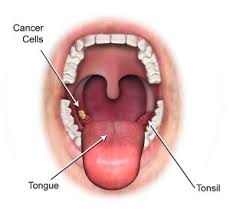 Nak tahu cara merawat tonsil tanpa perlu dibedah? Tonsil Berbahaya Jika Tidak Di Cegah Ini Punca Dan Rawatannya