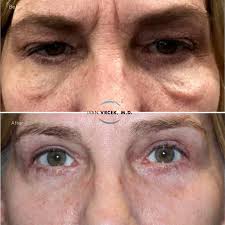 This patient had a very challenging problem: malar edema, also called  "festoons”, a collection of fluid underneath the skin. I developed a  technique that treats the festoons from above & below -