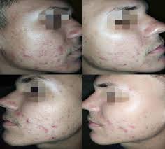 USO DO BARBATIMÃO ASSOCIADO AO ÁCIDO HIALURÔNICO PARA REJUVENESCIMENTO  FACIAL