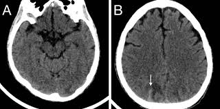 Un aneurisma cerebral es una zona abultada y débil en la pared de una arteria que suministra sangre al cerebro. Hemorragia Subaracnoidea No Traumatica Con Angiografia Por Tomografia Computada Inicial Negativa