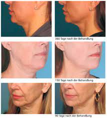 Maybe you would like to learn more about one of these? Hifu Hautstraffung Ohne Op Institut Fur Korperasthetik