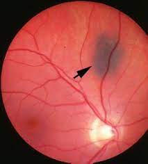 This Is A Picture Of Choroidal Nevus Which Has A Paler Color And Less Distinct Edge Than Chrpe Chrpe Is Retinal Photography Eye Anatomy Human Skeletal System