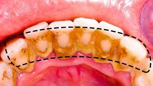 Aug 17, 2017 · to brush your teeth: How To Remove Tartar From Teeth At Home Naturally Arxiusarquitectura