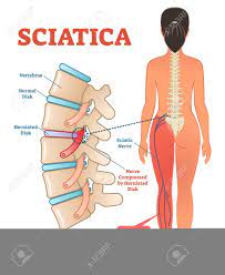 Chiropractic is great for back, neck and extremity pain. Sciatica Medical Health Care Vector Illustration Scheme With Royalty Free Cliparts Vectors And Stock Illustration Image 99797135