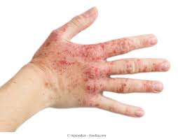 Medizinisch heißt der hautausschlag exanthem. Kontaktdermatitis Kontaktallergie Gesicht Augen Fingern Behandlung