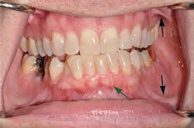 Image result for Labial mucosa