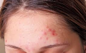 Washing your face two times a day is recommended, this will keep your forehead clean of any bacteria and everyday dead cells and dermis. What Your Acne Says About Your Health Reader S Digest