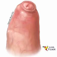 Image result for paraphimosis