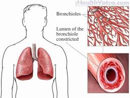 Aspergillosis is a condition caused by aspergillus mould. Aspergillosis Definition Causes Symptoms Complications And Cost Surgery Treatment Hospital In India