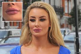 By abby rose for mailonline. Love Island S Chloe Crowhurst Sparks Rumours She S Plumped Up Her Pout With Fillers As She Is Spotted With Bruised Lips
