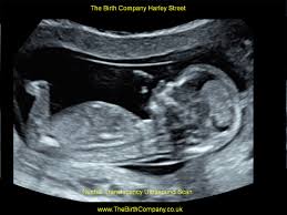 Sometimes women don't realize that they are pregnant because. Nuchal Translucency Scan 200 11 14 Weeks Pregnancy Scan The Birth Company