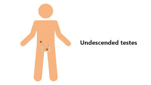 Cryptorchidism in boys with congenital abdominal wall defects. Undescended Testicles Cryptorchidism Causes Symptoms And Treatment