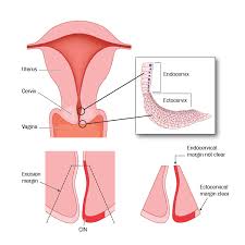 After reviewing the results of your most recent pap smear, your doctor suggests that you get a colposcopy. Treatment For Cin London Uk Thomas Ind