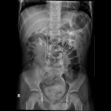Bilateral Duplex Kidneys With Left Sided Uterocoele Radiology Case Radiopaedia Org Kidney Duplex Radiology