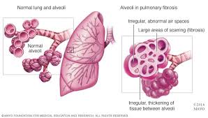 A commitment to the future. Pulmonary Fibrosis Symptoms And Causes Mayo Clinic