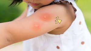 Check spelling or type a new query. 16 Rahasia Obat Digigit Serangga Aman Untuk Balita Orami