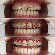Pin By Bibigv On Odontologia Estetica In 2021 Orthodontic Treatment Teeth Braces Braces Tips