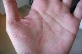 Ada beberapa cara yang bisa dilakukan untuk mengatasi kulit mengelupas. Silahkan Coba Sendiri Masalah Kulit Tangan Mengelupas Seketika Bisa Sembuh Dengan Cara Ini Semua Halaman Nakita