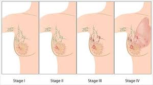 Finding breast lumps and seeing change in the size and shape. The Stages Of Breast Cancer What You Need To Know Everyday Health