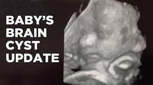Baby S Brain Cyst Update Youtube