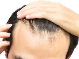 While many factors can contribute to thinness, male pattern baldness is the most common type of hair loss. Receding Hairline Treatment Stages And Causes
