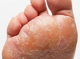 From the irritation of tight or stuffy shoes to direct contact with contaminated surfaces to overexposure to the elements, there are many reasons why the skin on your feet may start to peel. Athletes Foot Foot Medical Centre Aurora Foot Specialist Aurora Podiatrist