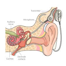 Image result for Cochlear Implant