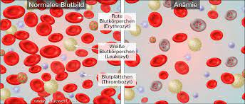 Hamoglobin Zu Niedrig Blutwert Hb Vermindert Anamie