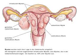 Besonders frauen im gebärfähigen alter entwickeln häufig gutartige wucherungen in der gebärmutter, so genannte myome. Gebarmuttermyome Uterusmyome Eesom Gesundheitsportal
