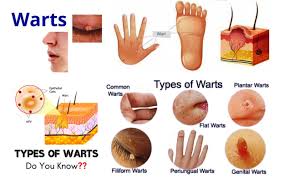 Almost all types of hpv cause relatively harmless warts that appear on your hands or feet. Warts Homeopathic Treatment