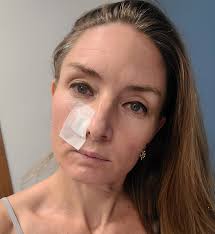 Dealing with Basal Cell Carcinoma and Receiving Community Support