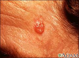 Image result for skin cancer on nose pimple