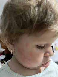 Buna ziua! Fetita mea e suspecta de alergie la proteina din lapte. Are 5  luni. Simptome scaun cu mucus. Este alaptata.ce vroiam sa întreb? Alergia  asta trece sau asa rămâne mereu?mulțumesc. |