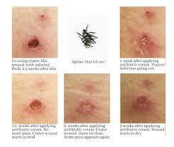 Image result for wolf spider bite skin