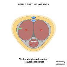 I even get that same sensation at low tension. Penile Fracture Grading Radiology Reference Article Radiopaedia Org
