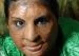 St John's Hospital to cut beds in burns unit by almost 50%