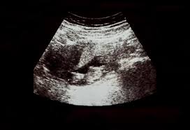 A reason for this is done when the right to having a dating scan after the results given your. 9 Weeks Pregnant Ultrasound Procedure Abnormalities And More