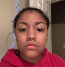 This is my 16 year old daughter. She has been using the 3 in 1 cleansing  bar for 5 consecutive weeks to clear her acne. Look at her progress!!! 🚨  🚨 🚨