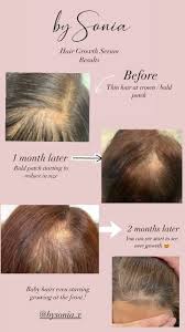 While new hair will generally be in the same growth phase—and thus the same length—damaged hair will vary in length and may appear kinked, look irregular, or have thin, frayed ends, he explains. By Sonia Hair Growth Serum Results